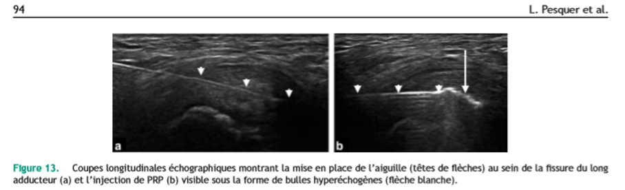 Déchirure du tendon fig.01