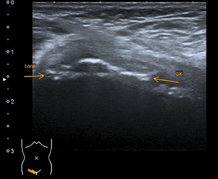 Déchirure du tendon fig.02