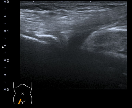 Déchirure du tendon fig.03