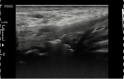 Déchirure du tendon fig.05