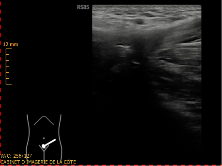 Déchirure du tendon fig.06