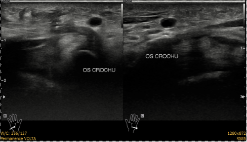 Os crochu fig.03
