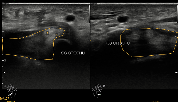 Os crochu fig.04